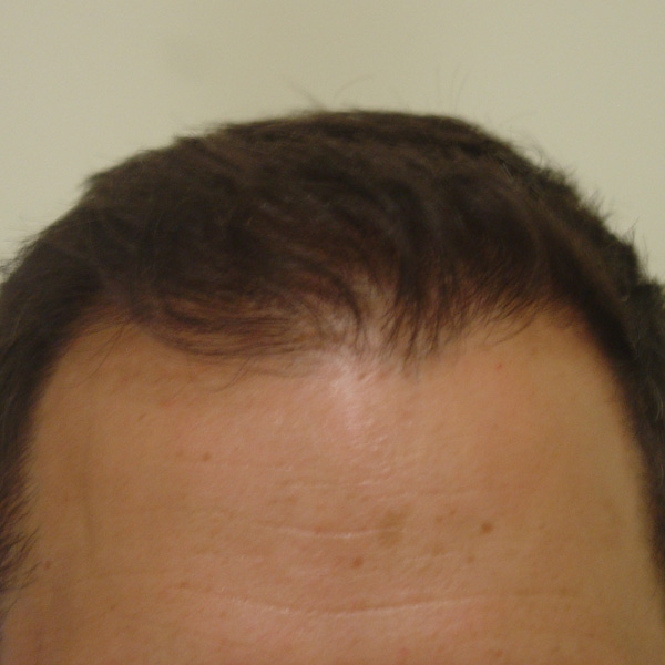 After Hair Transplant 01 - 2017