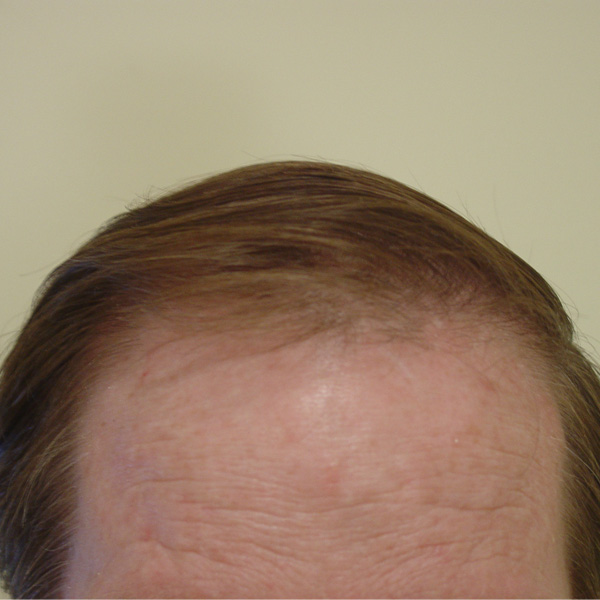 After Hair Transplant 02 - 2017