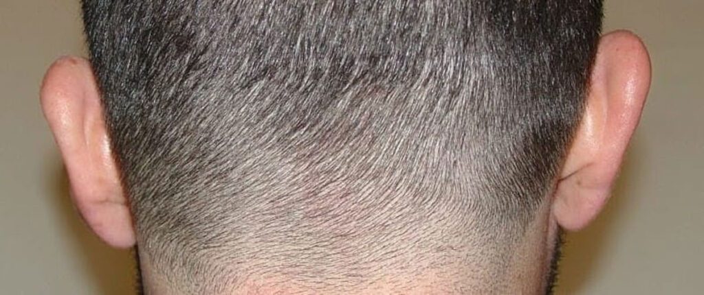 Transplant Techniques Image 2