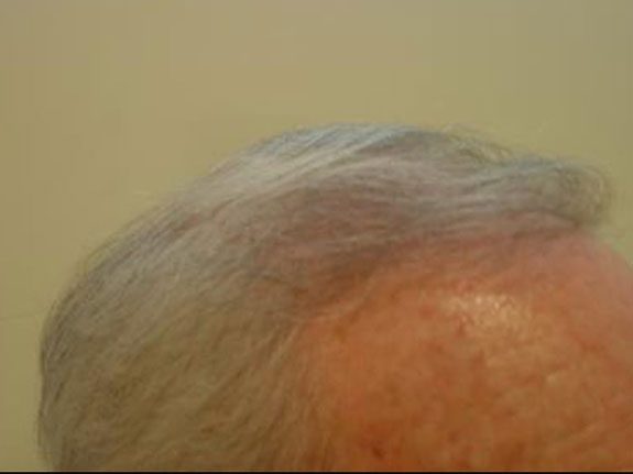 Before & After Scalp Image After 6