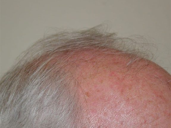 Before & After Scalp Image Before 6