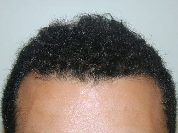 Before & After Scalp Image After 7