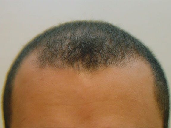 Before & After Scalp Image Before 7