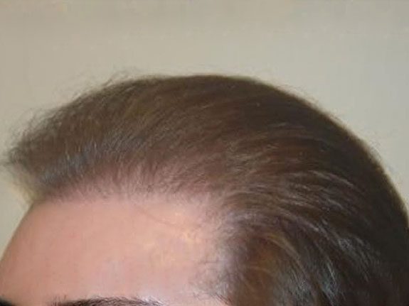 Before & After Scalp Image After 8