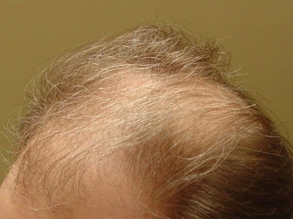 Before & After Scalp Image Before 8