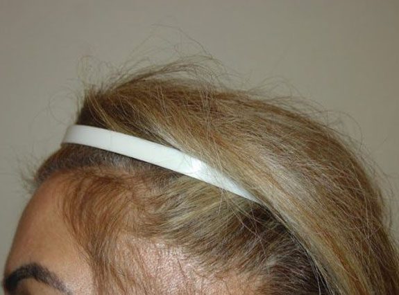 hair-restoration-03-Before_mod