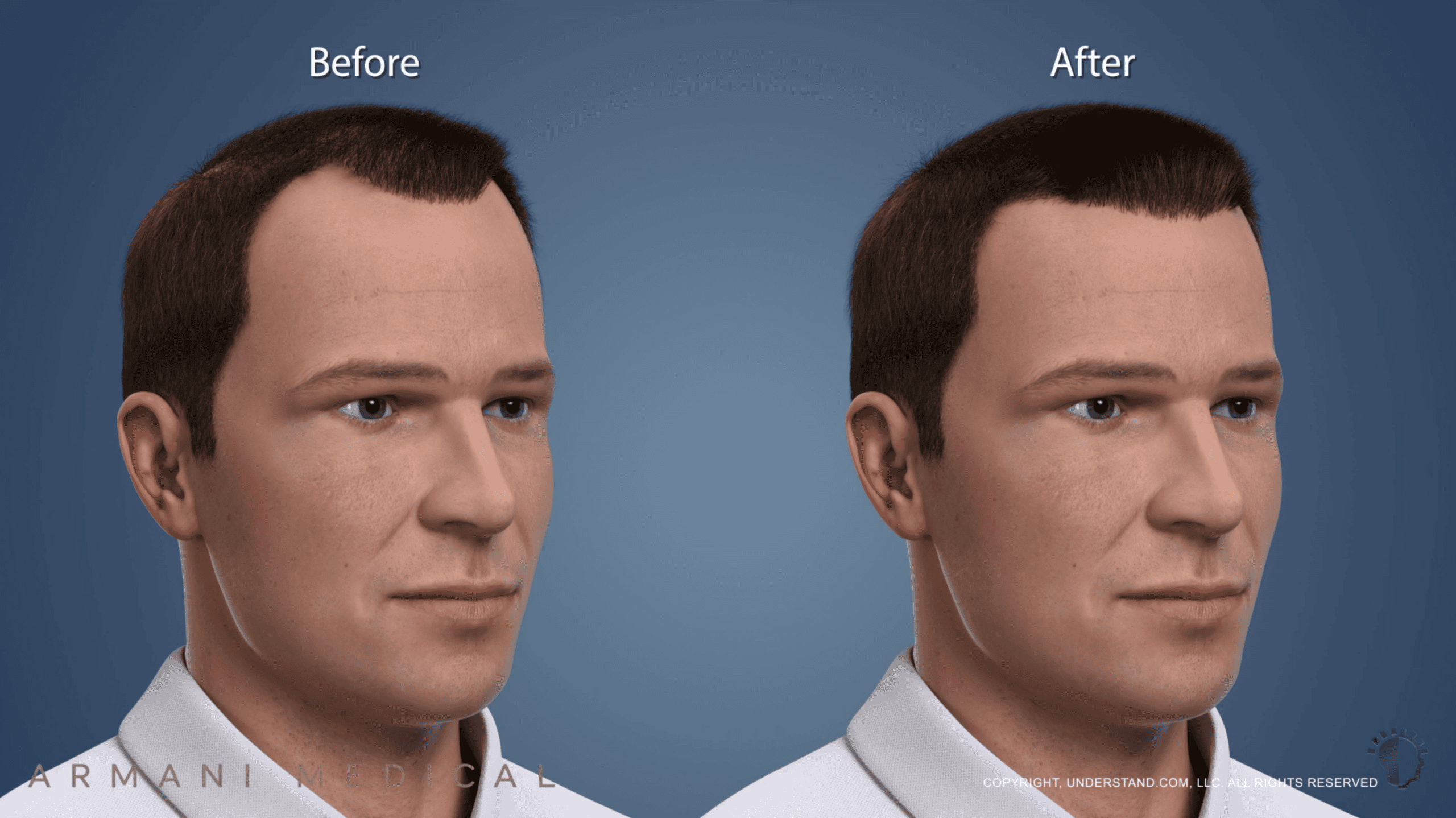 Armani Medical Hair Transplant Explaination Video