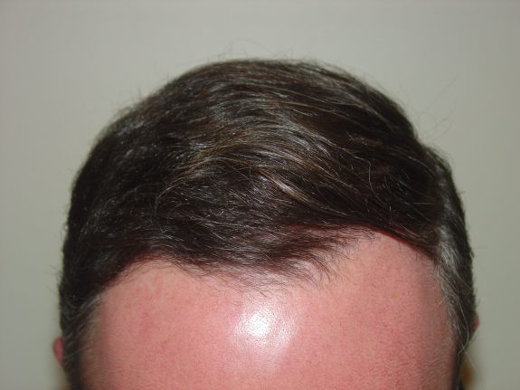 Before & After Scalp Image After 2