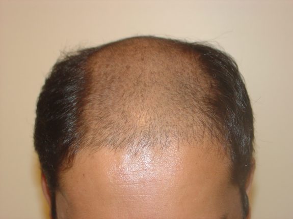 Before & After Scalp Image Before 3