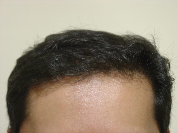 Before & After Scalp Image After 3