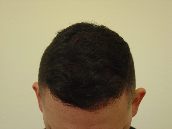 Before & After Scalp Image After 1