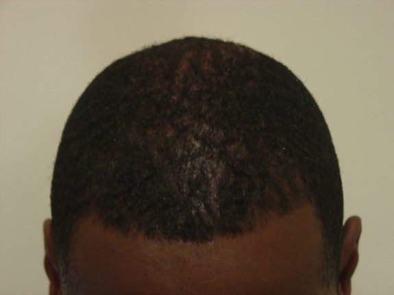 Hair Restoration Example - After 30