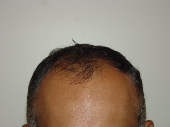 Before & After Scalp Image After 4