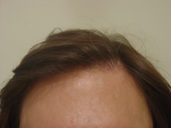 Hair Restoration Example - After 26