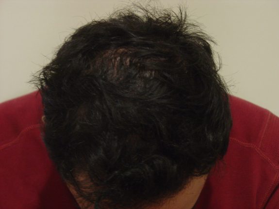 Hair Restoration Example - After 22