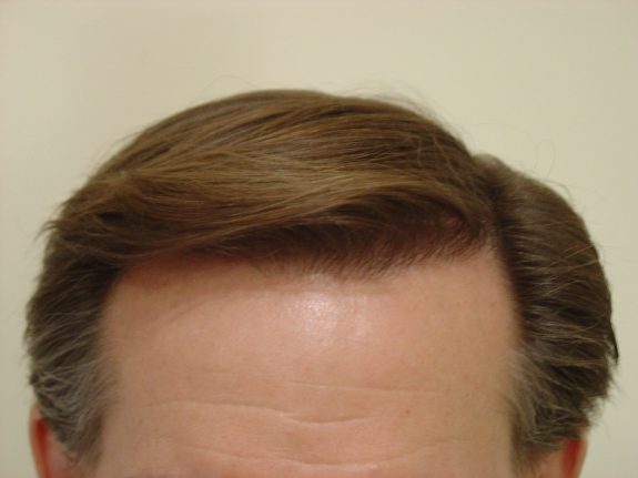 Hair Restoration Example - After 23