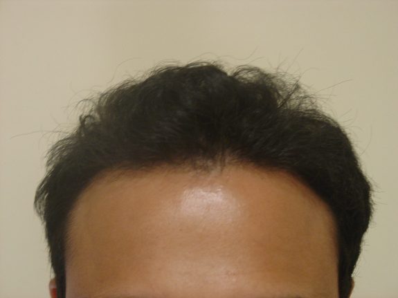 Hair Restoration Example - After 25