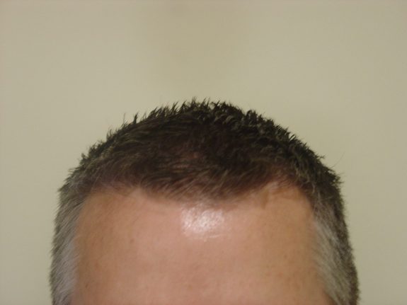 Hair Restoration Example - After 29