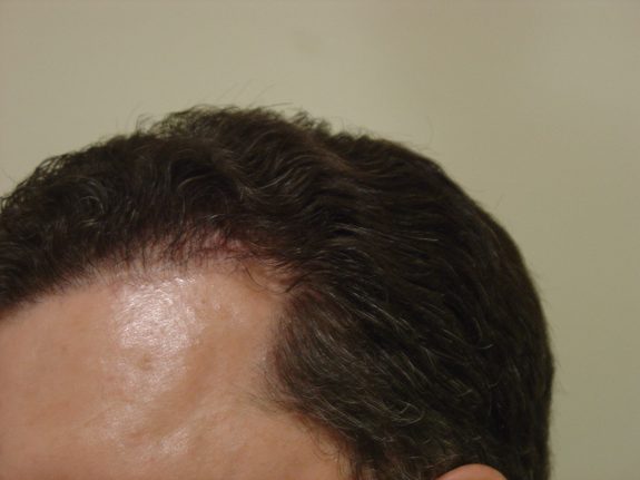 Hair Restoration Example - After 31