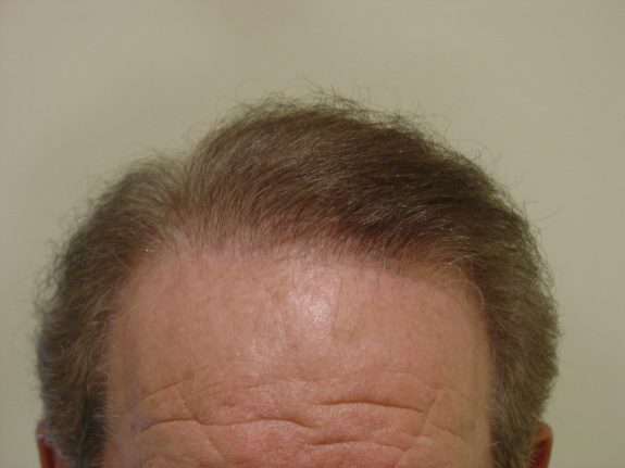 Hair Restoration Example - After 32