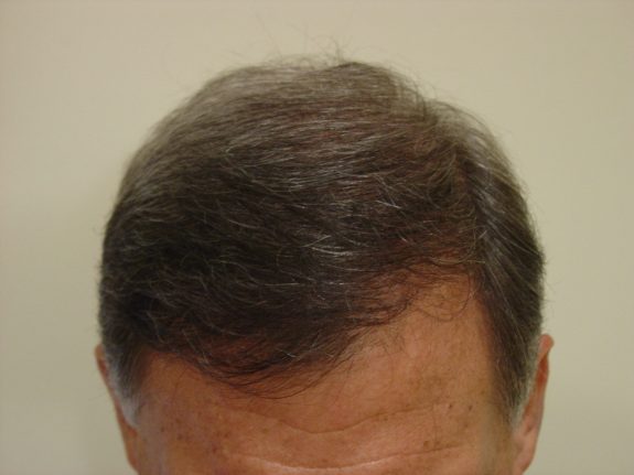 Hair Restoration Example - After 33