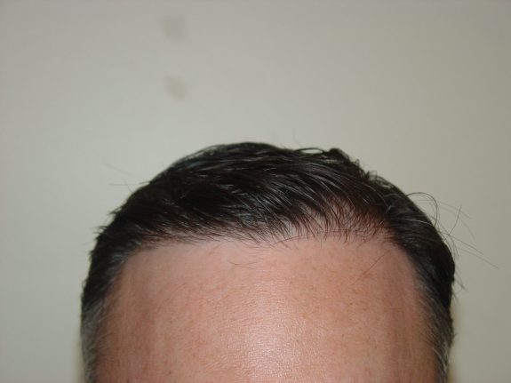 Hair Restoration Example - After 34