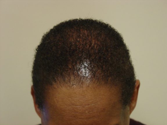 Hair Restoration Example - After 36
