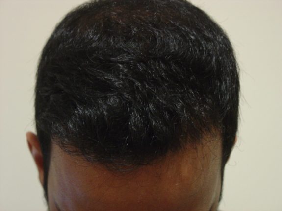 Hair Restoration Example - After 37
