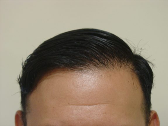Hair Restoration Example - After 38