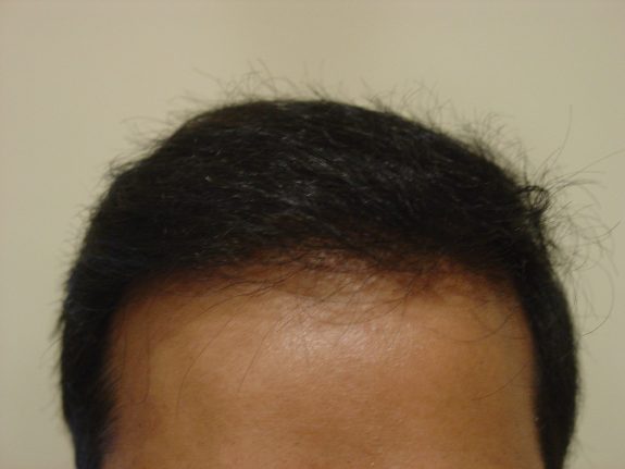 Hair Restoration Example - After 39