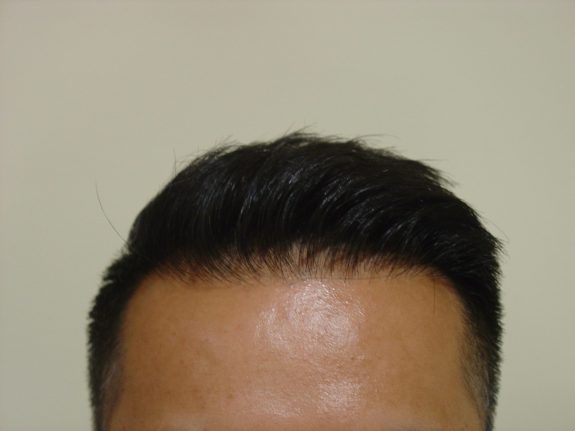 Hair Restoration Example - After 40