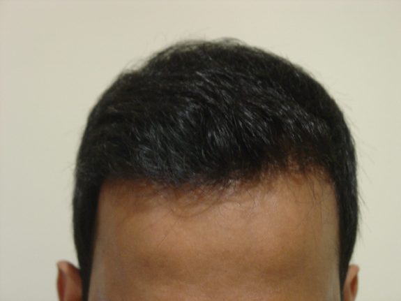 Hair Restoration Example - After 65