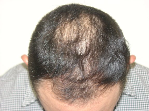 Before & After Scalp Image Before 1