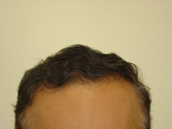 Before & After Scalp Image Before 4