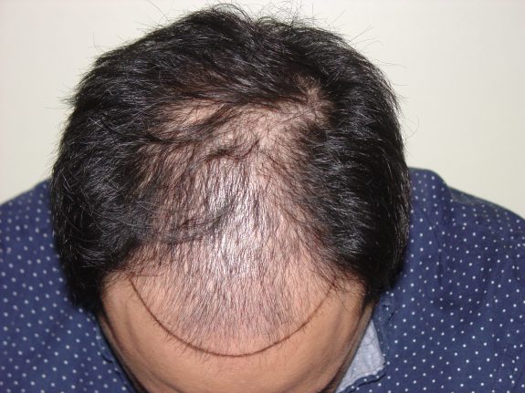 Hair Restoration Example - Before 22