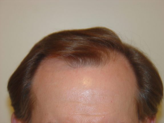 Hair Restoration Example - Before 23