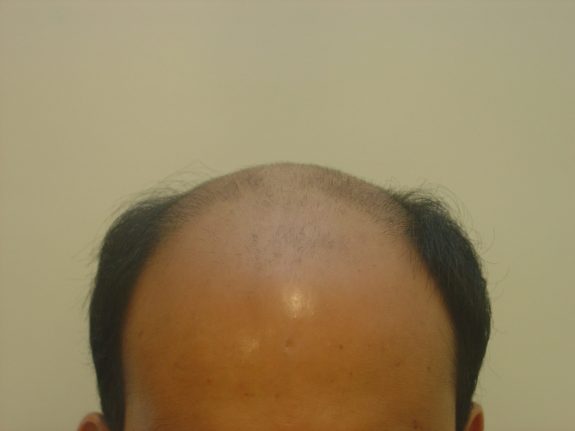 Hair Restoration Example - Before 24