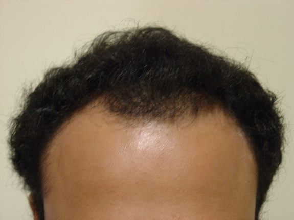 Hair Restoration Example - Before 25