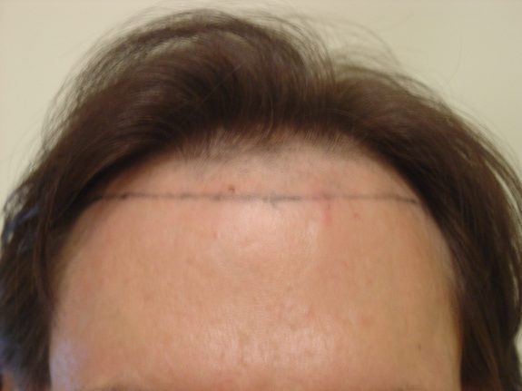 Hair Restoration Example - Before 26