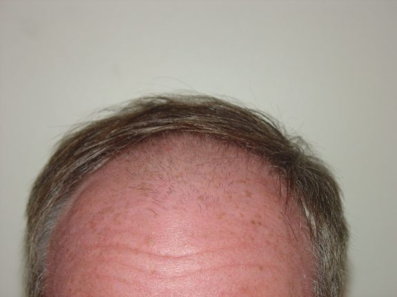 Hair Restoration Example - Before 28