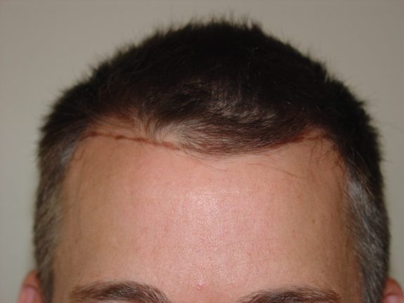 Hair Restoration Example - Before 29