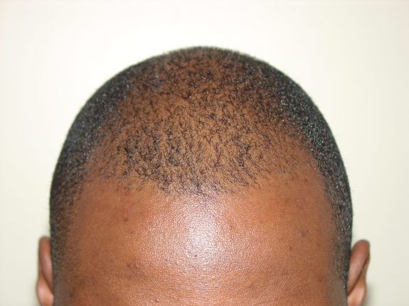 Hair Restoration Example - Before 30