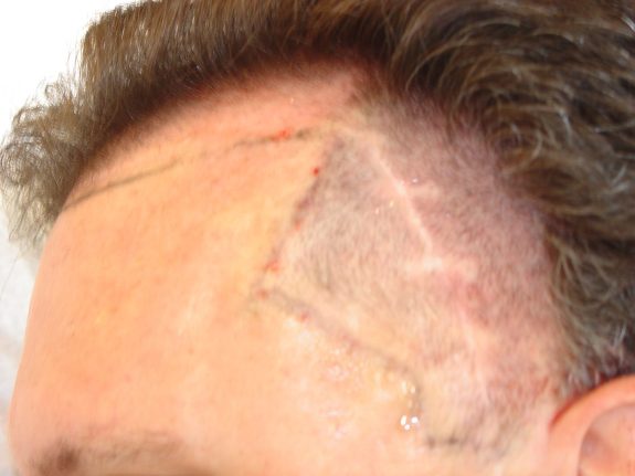 Hair Restoration Example - Before 31