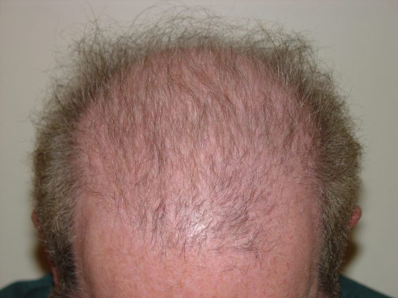 Hair Restoration Example - Before 32