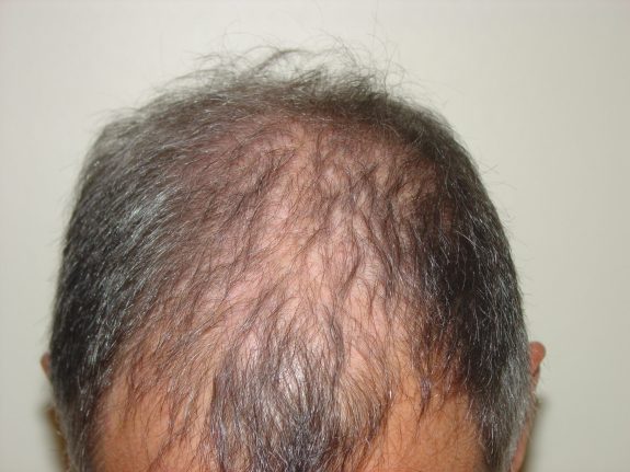 Hair Restoration Example - Before 33