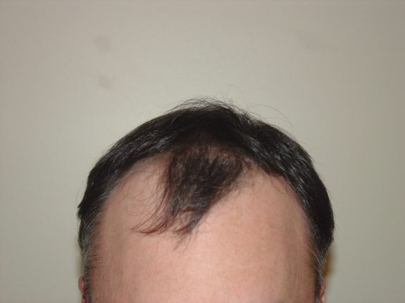 Hair Restoration Example - Before 34
