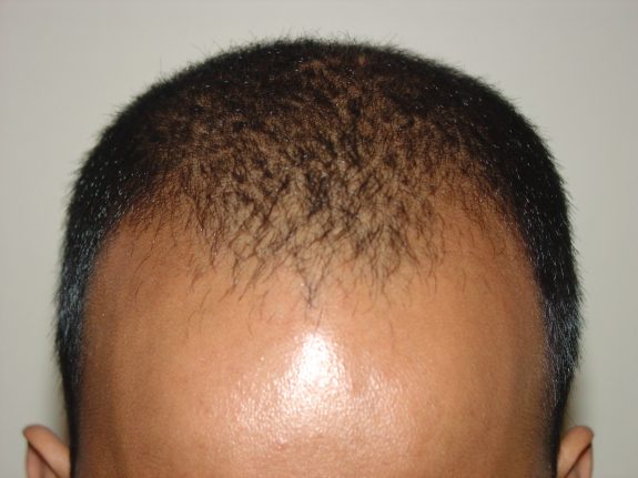 Hair Restoration Example - Before 35