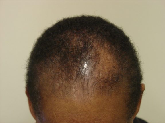 Hair Restoration Example - Before 36