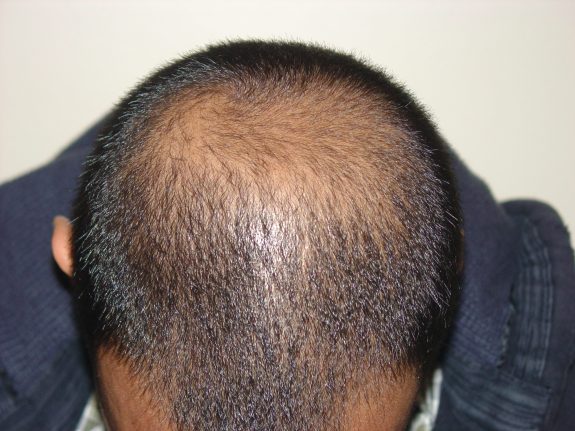 Hair Restoration Example - Before 37