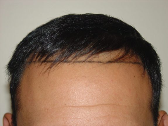 Hair Restoration Example - Before 38